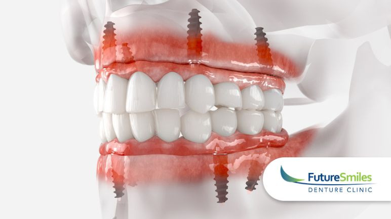 Dispelling Common Myths Surrounding Denture Implants